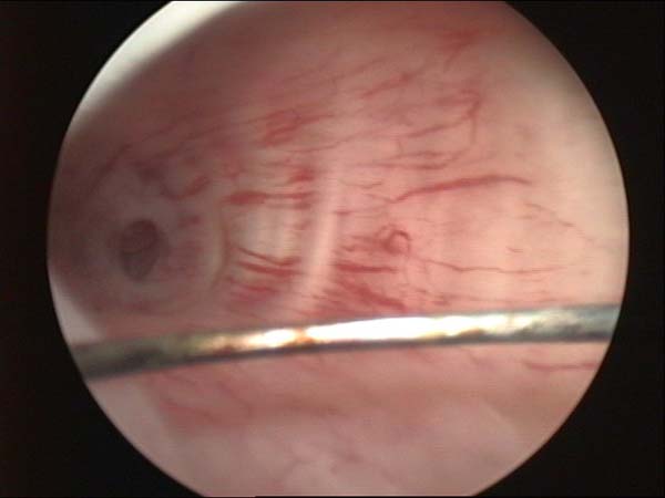 opening of fallopian tube