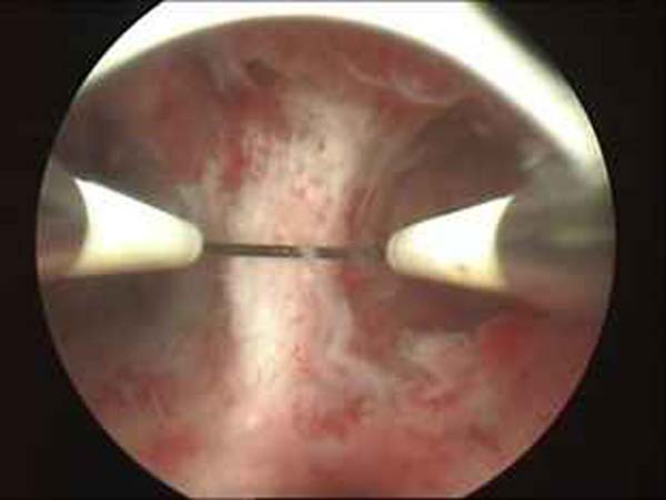 resection of uterine septum