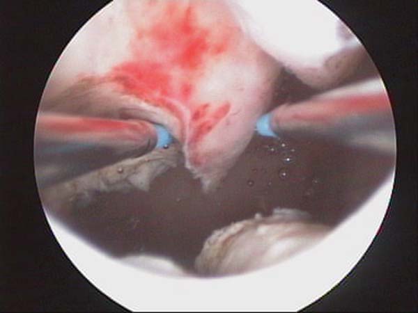 sub mucous fibroid