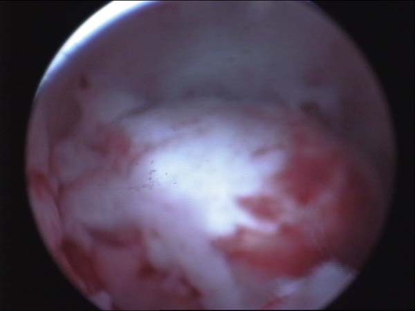 sub mucous fibroid