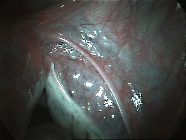 congenital absence of fallopian tube, replaced by a band