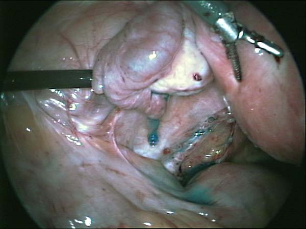 dye flowing from the fimbrial end