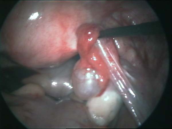 fallopian tube cyst