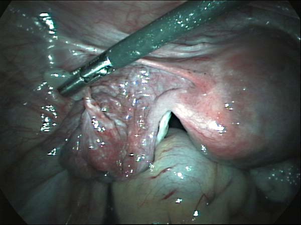 fallopian tube cyst