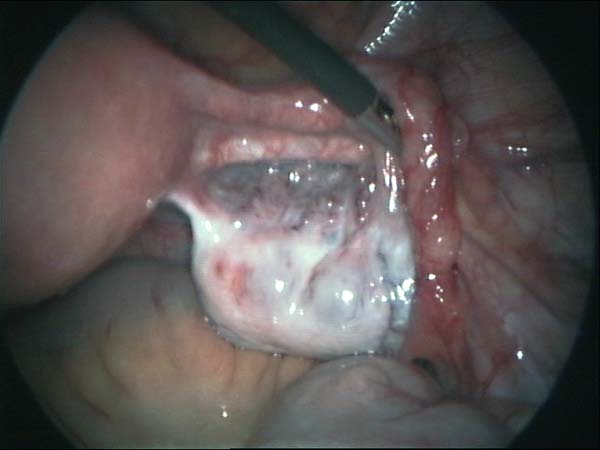 ovary and fallopian tube