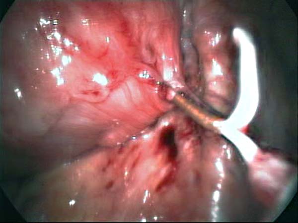 iucd through uterine wall