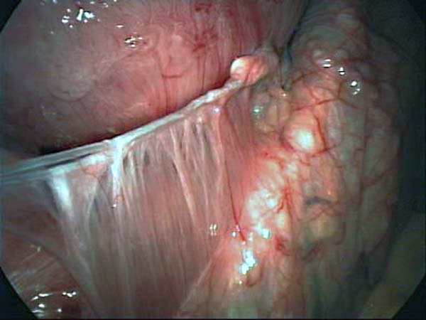 iucd through uterine wall