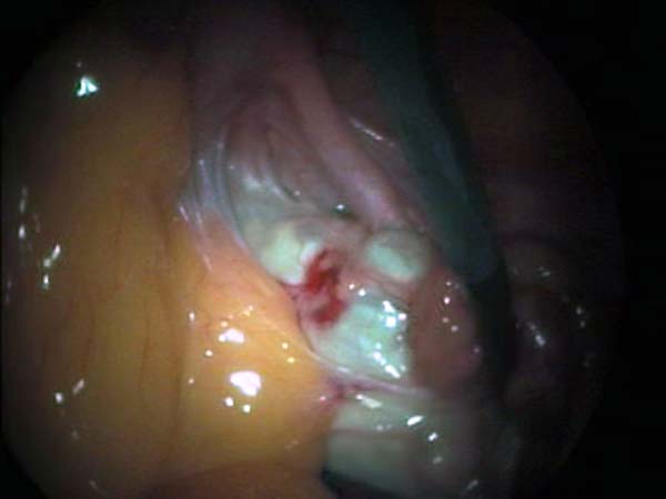 dissection adhérences épiploïque à l'ovaire
