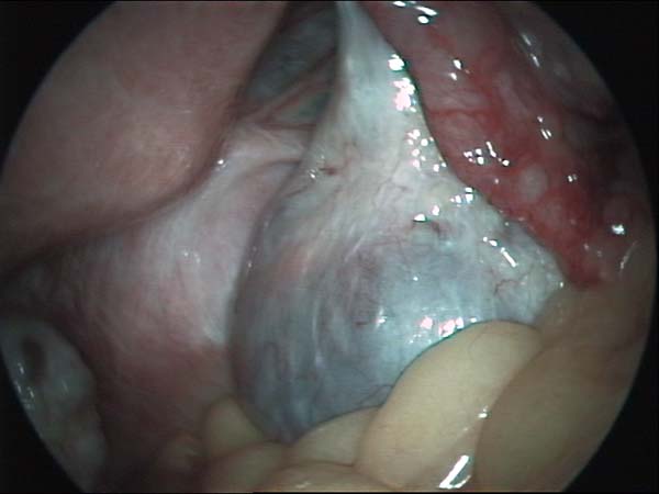 ovarian cyst