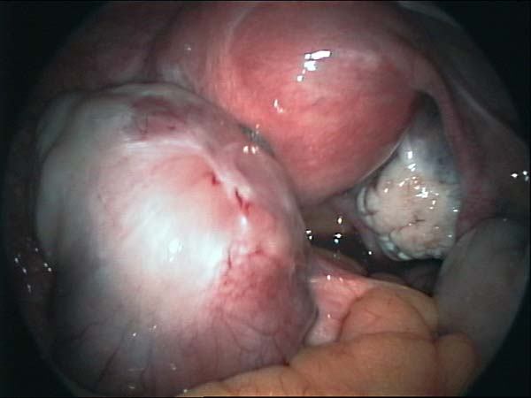 ovarian cyst