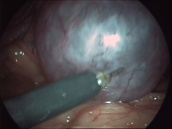 puncturing ovarian cyst