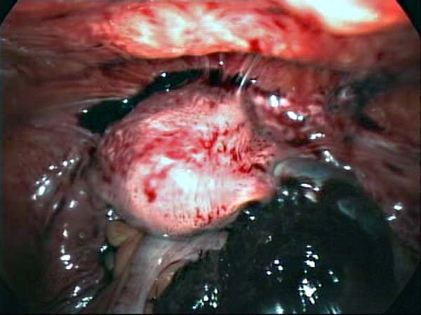 uterine adhesions to anterior abdomial wall