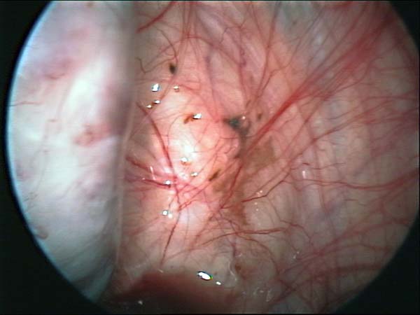 Spots endométriosiques