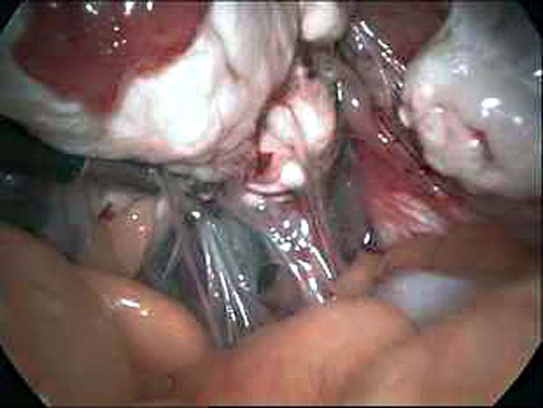 ovarian adhesions