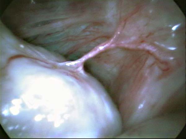 ovarian adhesions