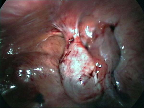 ovary adherent to abdominal wall 3