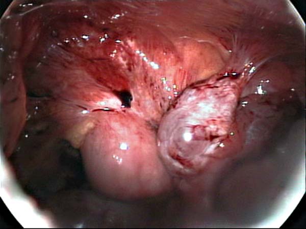 ovary adherent to abdominal wall 3