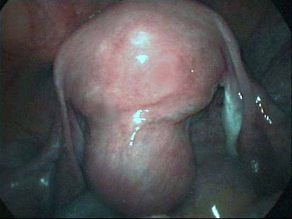 Uterine fibroid