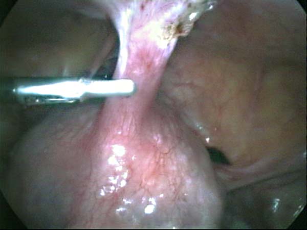 dissecting uterine adhesions