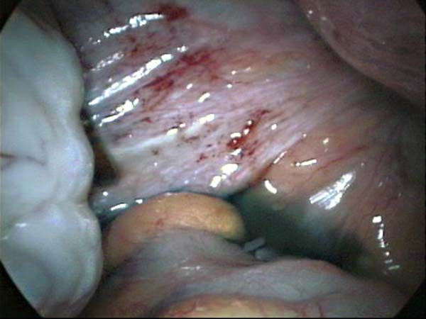 spots endométriosiques