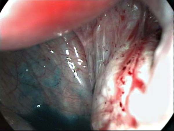 endometriotic spots