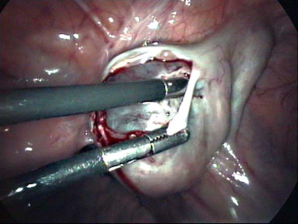 laparoscopic ovarian cystectomy