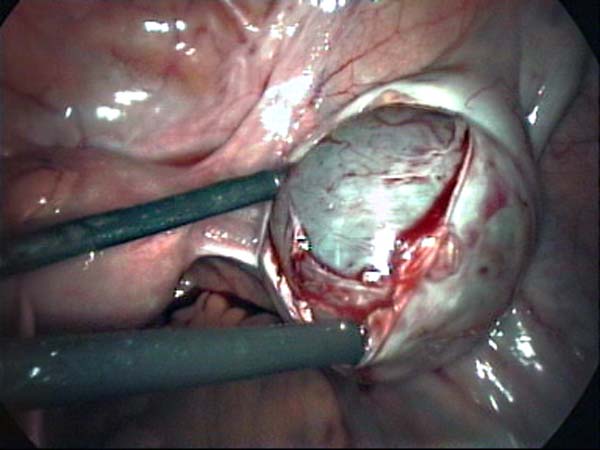 laparoscopic ovarian cystectomy