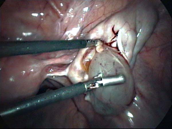 laparoscopic ovarian cystectomy