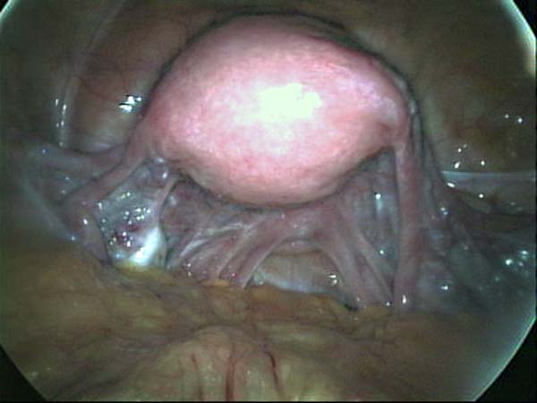 normal uterus