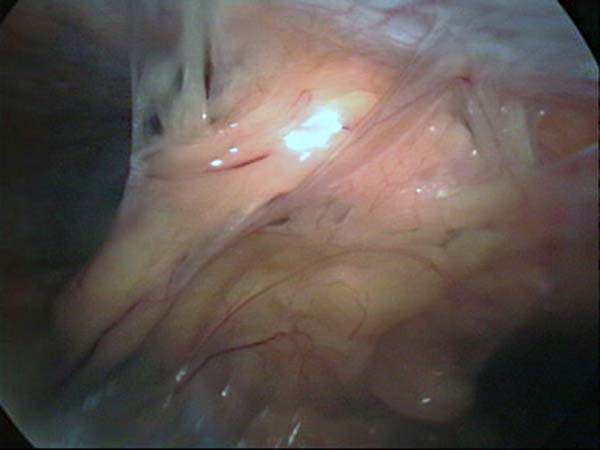 omental adhesions