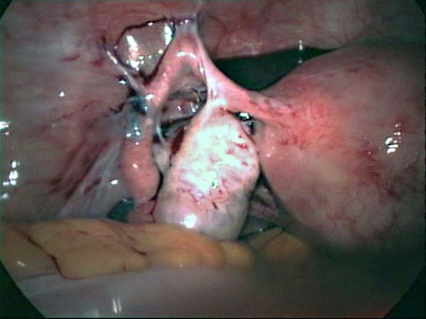 omental adhesions