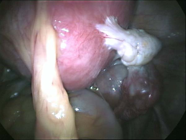 ovarian adhesions to the uterus