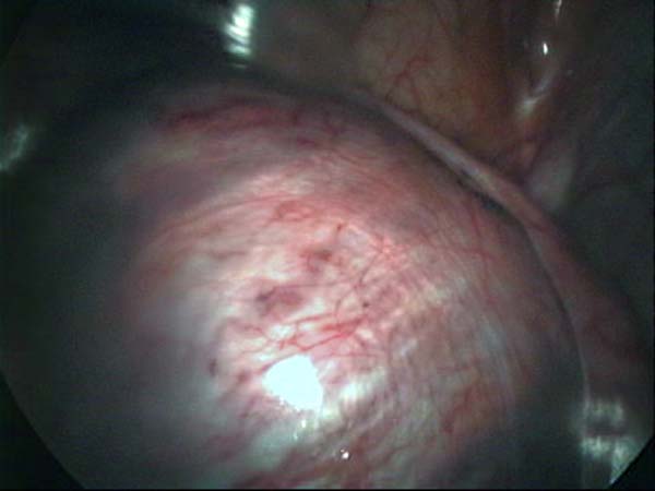 ovarian cyst