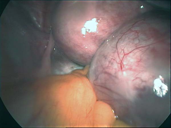 ovarian cyst