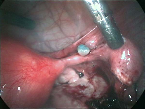 tubal diverticules