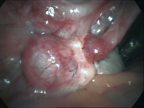 tubo ovarian adhesions