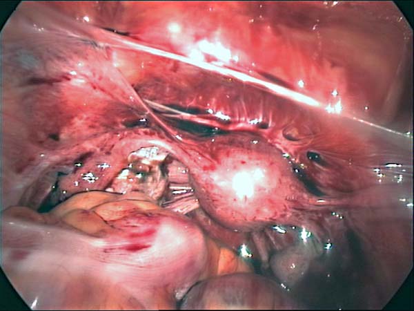 uterine adhesions