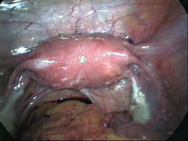 uterine septum