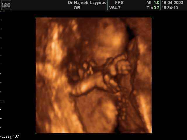 Fetal Hand 14 weeks