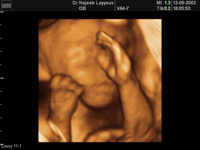 Fetal Hands