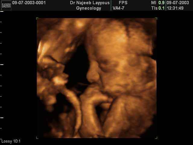 fetal profile