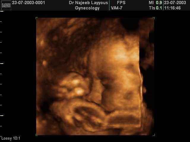 fetal profile