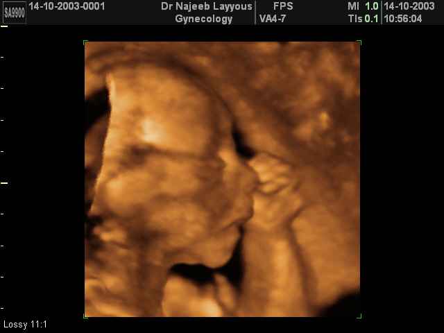 fetal profile