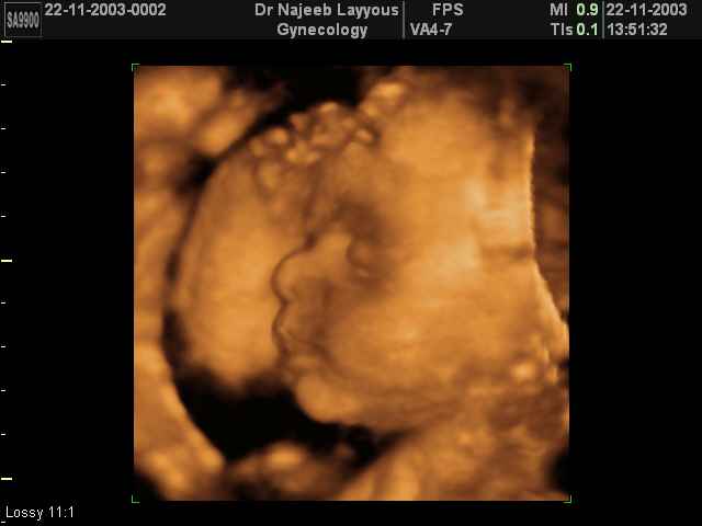 fetal profile