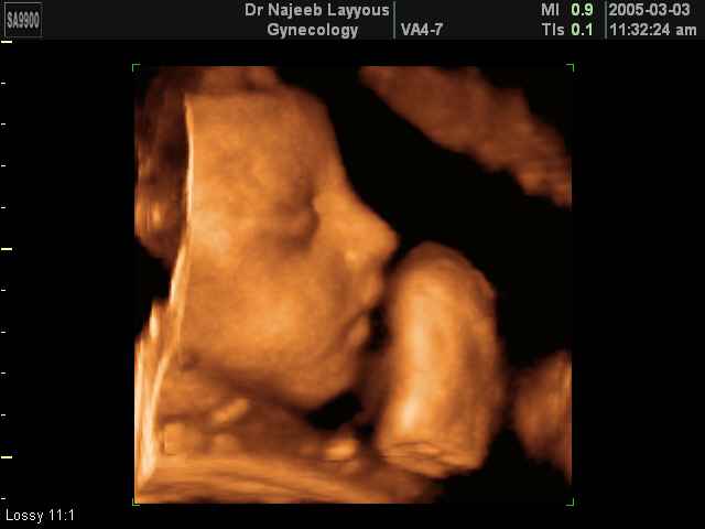 fetal profile