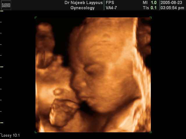 fetal profile