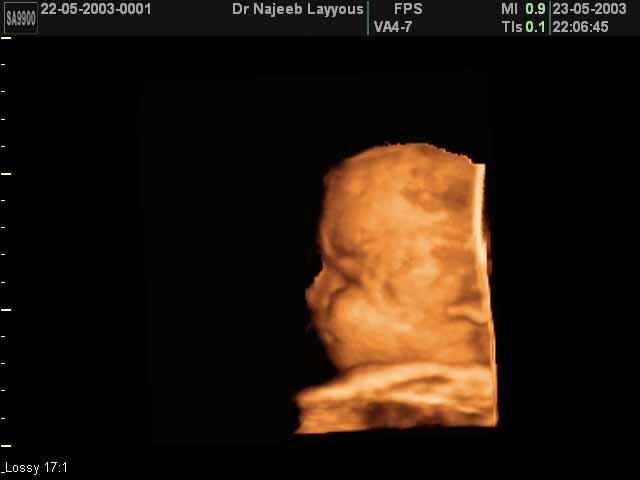 fetal profile
