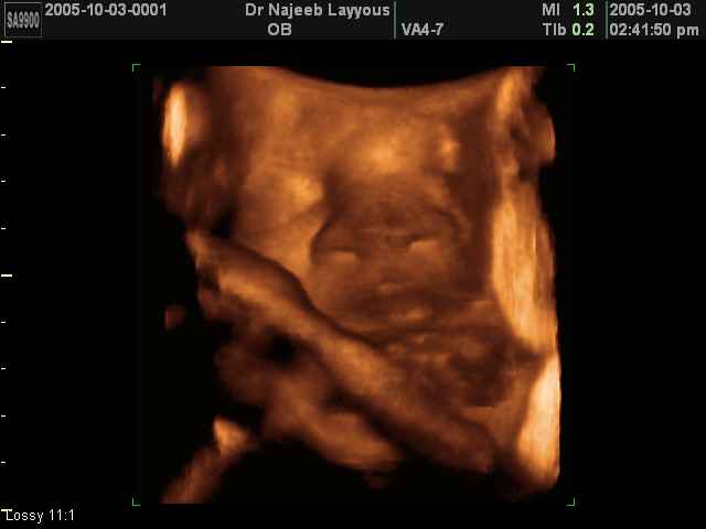 Fetal Nose