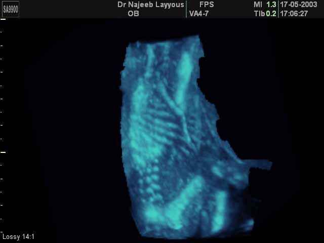 3D Photos échographie du squelette du fœtus