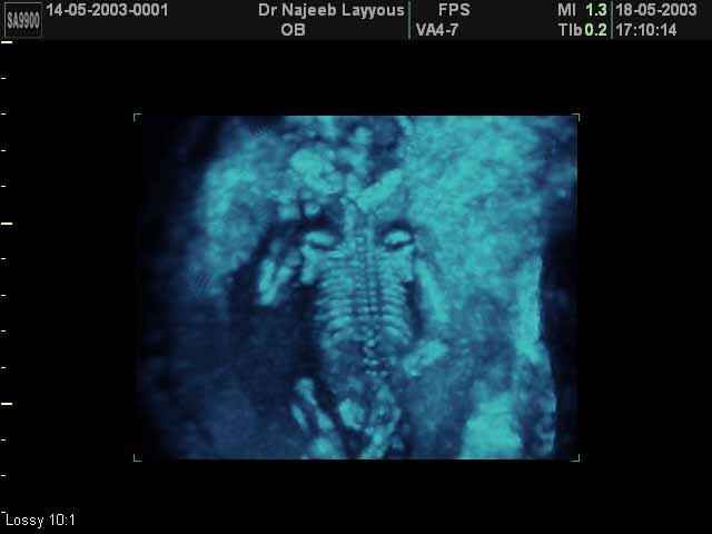 Fetal Skeleton